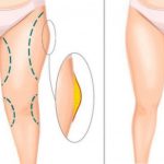 Липосакция бедер: Все, что нужно знать о процедуре