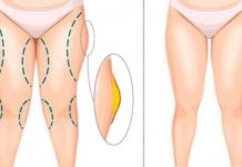 Липосакция бедер: Все, что нужно знать о процедуре