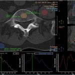 КТ-Денситометрия Костей: Современные Технологии в Диагностике Остеопороза