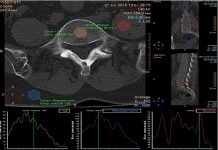 КТ-Денситометрия Костей: Современные Технологии в Диагностике Остеопороза