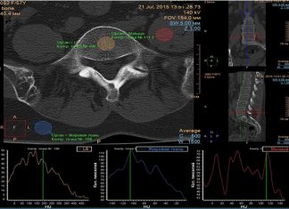 КТ-Денситометрия Костей: Современные Технологии в Диагностике Остеопороза