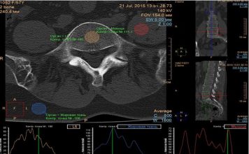 КТ-Денситометрия Костей: Современные Технологии в Диагностике Остеопороза