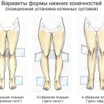 Преимущества операций по коррекции кривизны ног и увеличению роста человека