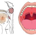 Что нужно знать о раке горла: риски, симптомы, терапия