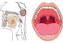 Что нужно знать о раке горла: риски, симптомы, терапия