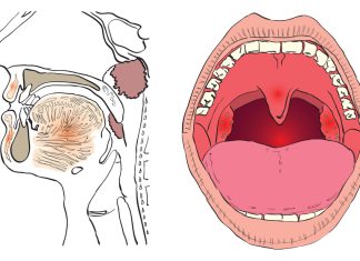 Что нужно знать о раке горла: риски, симптомы, терапия