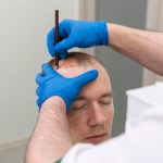 Пересадка волос: Современные методы и инновационные технологии