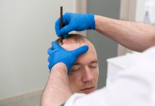 Пересадка волос: Современные методы и инновационные технологии