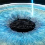 Лазерная коррекция зрения: как это работает и кому подходит