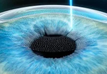 Лазерная коррекция зрения: как это работает и кому подходит