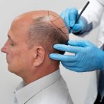 Прямая пересадка волос: инновационный метод восстановления волос