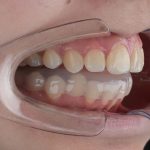 Что такое сплинт-терапия ВНЧС?