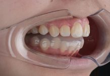 Что такое сплинт-терапия ВНЧС?