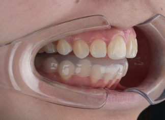 Что такое сплинт-терапия ВНЧС?