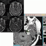 Невралгия тройничного нерва: Симптомы, причины и методы лечения