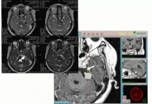 Невралгия тройничного нерва: Симптомы, причины и методы лечения