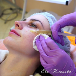 Плазмолифтинг: что это и зачем он нужен