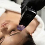 Игольчатый RF: Новая эра в радиочастотной терапии