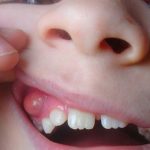 Лечение кисты зуба: что нужно знать