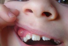 Лечение кисты зуба: что нужно знать