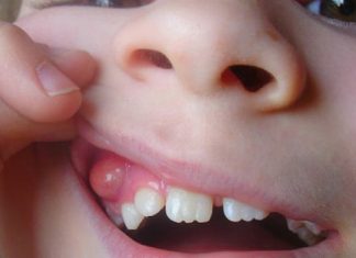 Лечение кисты зуба: что нужно знать