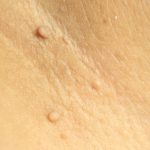 Удаление папиллом лазером