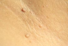 Удаление папиллом лазером