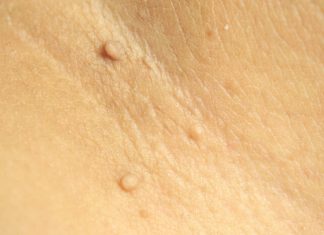 Удаление папиллом лазером