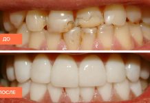 Может ли под винирами образовываться кариес?