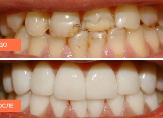 Может ли под винирами образовываться кариес?