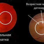 Как защититься от возрастной макулярной дегенерации