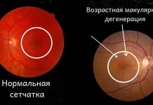 Как защититься от возрастной макулярной дегенерации