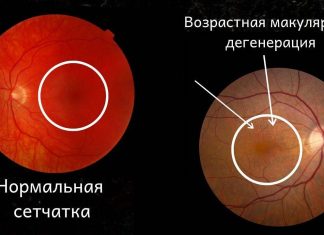 Как защититься от возрастной макулярной дегенерации