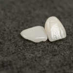 Коронка на зуб: что нужно знать перед установкой