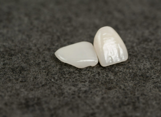 Коронка на зуб: что нужно знать перед установкой