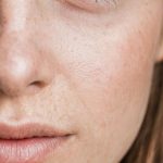 Как и почему появляются пигментные пятна на коже