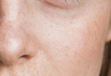 Как и почему появляются пигментные пятна на коже