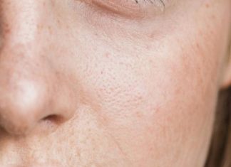 Как и почему появляются пигментные пятна на коже