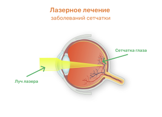 Боремся за зрение: Современные подходы к лечению заболеваний сетчатки
