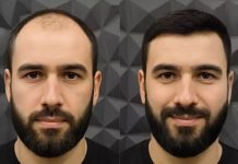 Как проходит процедура по пересадке волос