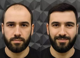 Как проходит процедура по пересадке волос