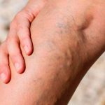 Диагностика венозных заболеваний: важные этапы и современные подходы