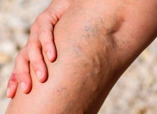 Диагностика венозных заболеваний: важные этапы и современные подходы