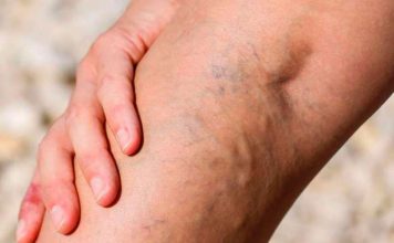 Диагностика венозных заболеваний: важные этапы и современные подходы